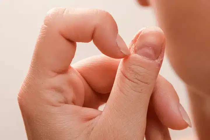 Dermatillomania